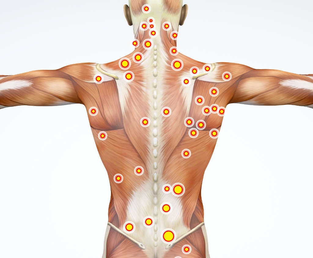 Back view of a man and his trigger points. The ML830 Smart Laser is the ideal device Trigger point therapy